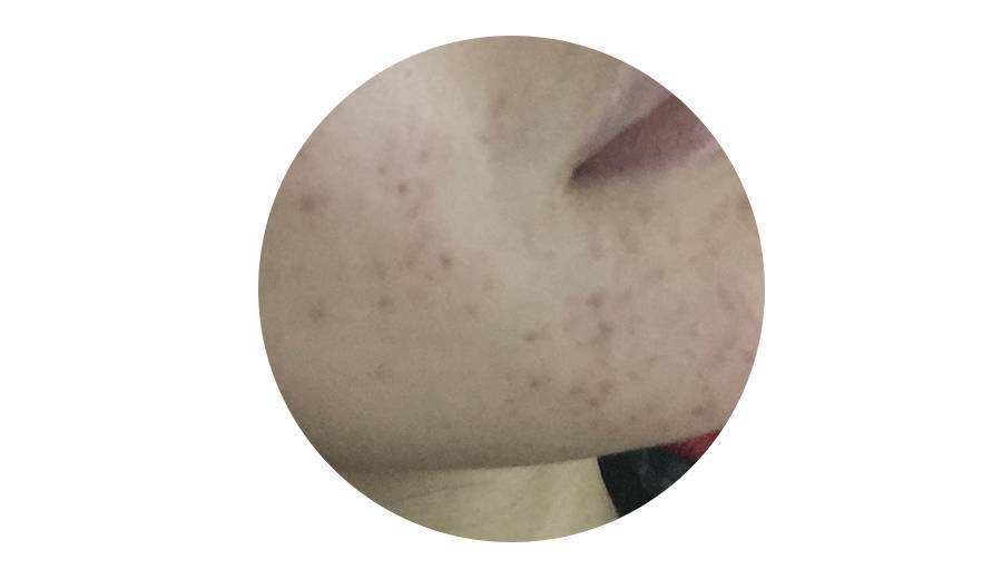 痘印淡化且不留痕迹方法男生,痘印有效去除