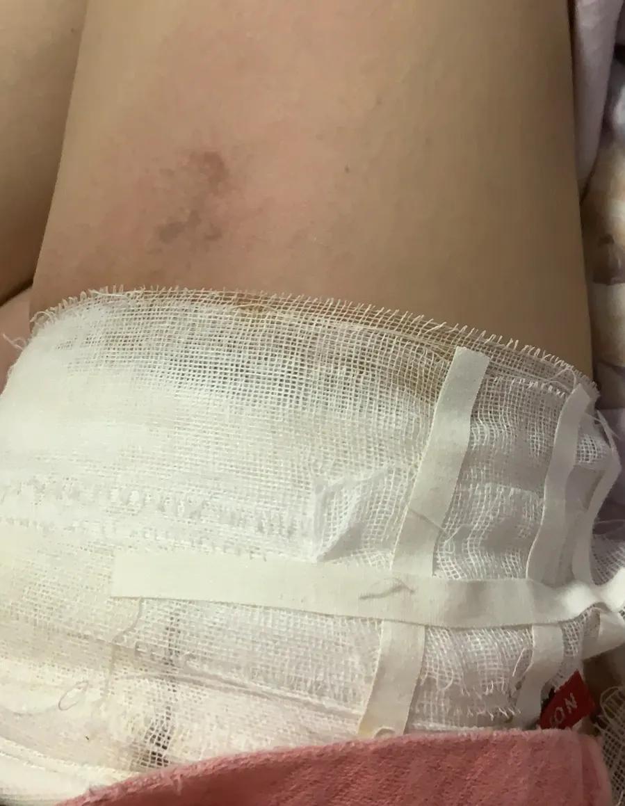 浅二度烫伤14天恢复图片,宝宝浅二度烫伤多久能恢复正常