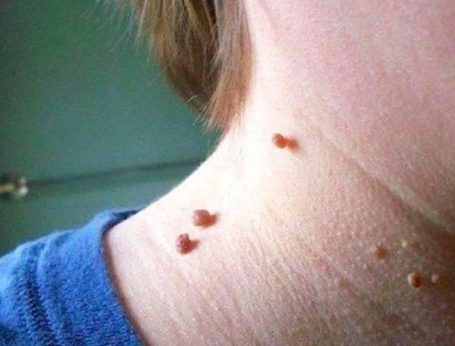 皮肤上的小肉球是怎么回事,皮肤上的小肉球是什么