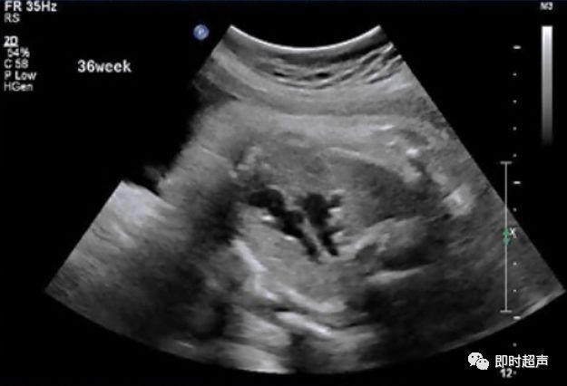 胎儿心脏三种血管关系模式图,25周的胎儿心脏弓切面多少正常