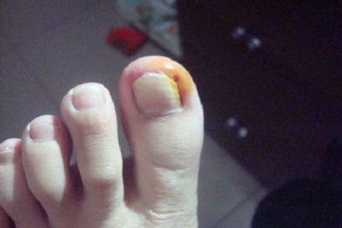 甲沟炎去修脚店要留指甲吗,脚指甲有甲沟炎怎么处理