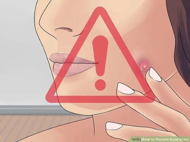 长完痘的红色痘坑怎么弄,怎么预防痘坑形成