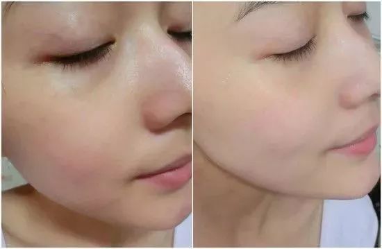 目前针对黑头最科学的方法,黑头正确处理后还会越长越多吗