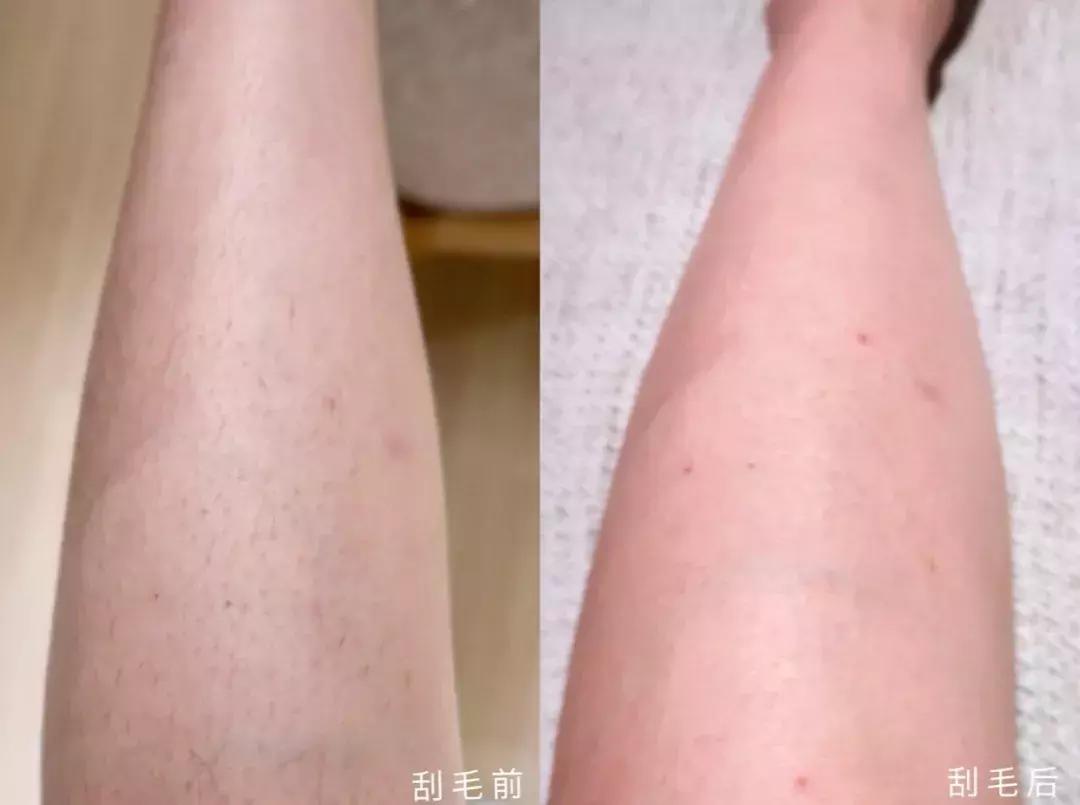 史上最实用脱毛术!夏天再也不为这事发愁啦