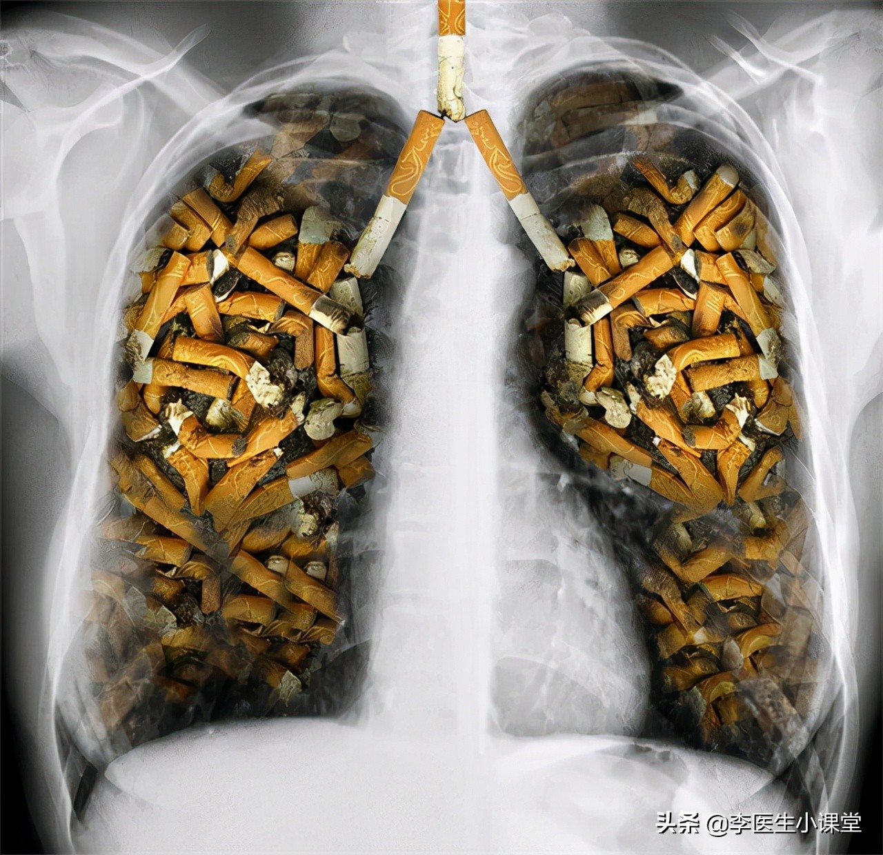 戒烟后黑肺能变原样吗,戒烟后原本黑的肺会好吗