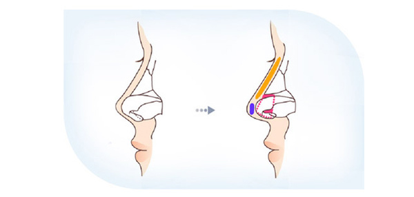 什么是鼻小柱图片,什么是鼻小柱延长