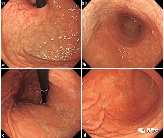 做胃镜怎样配合医生才不感觉痛苦,做胃镜的医生说不严重靠谱吗