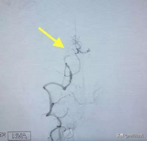 脑血管病介入治疗的介绍,缺血性脑血管病介入治疗进展2015