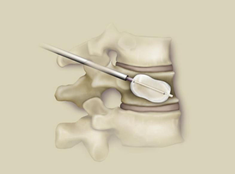 老年人半边腰痛怎么回事,老年人腰部摔伤疼痛怎么治疗