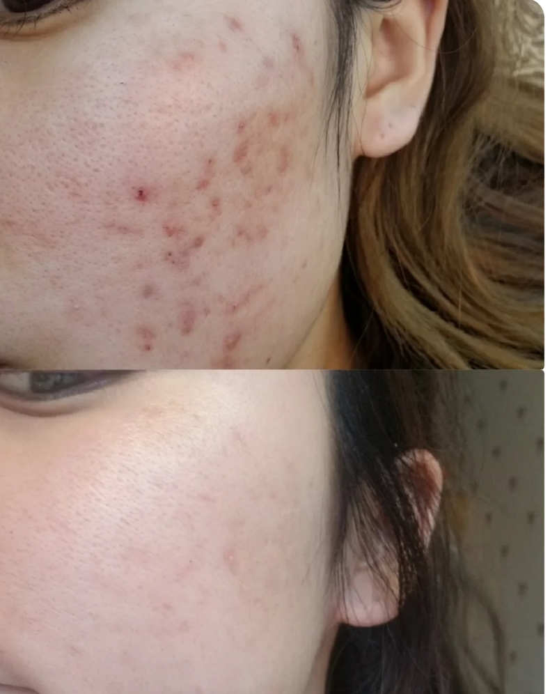 平价祛痘精华液,祛痘祛痘印的精华液推荐