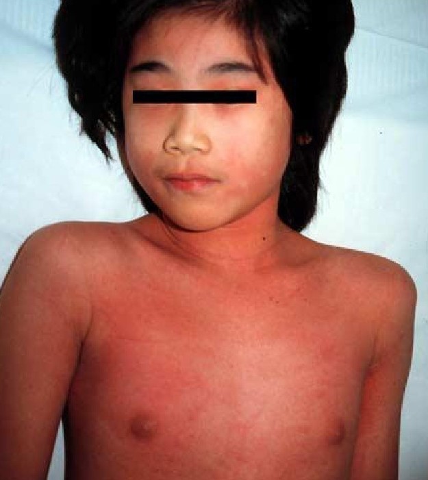 有发热和皮疹别忽视猩红热,猩红热先出红疹后发烧