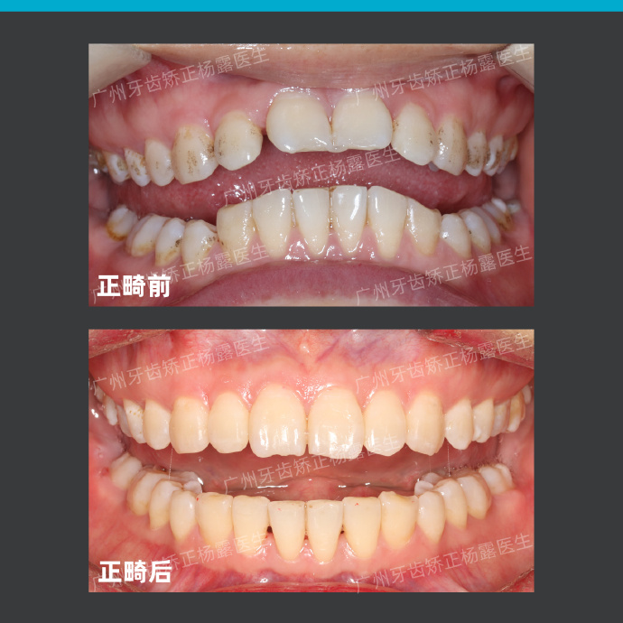 广州牙齿矫正整牙视频,牙齿深覆盖加龅牙怎么矫正