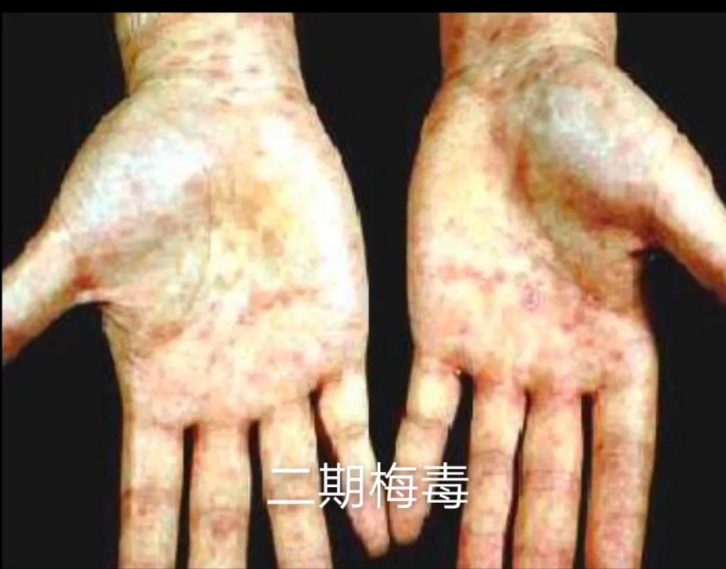 梅毒深入了解,怎样了解自己有没有梅毒