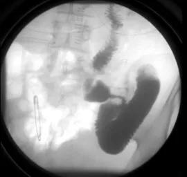 从胃炎到胃癌需要四步,从胃炎到胃癌往往出现这4个迹象