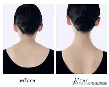 瘦脸针瘦腿针瘦肩针该怎么选,瘦肩针跟瘦脸针是不是一样的