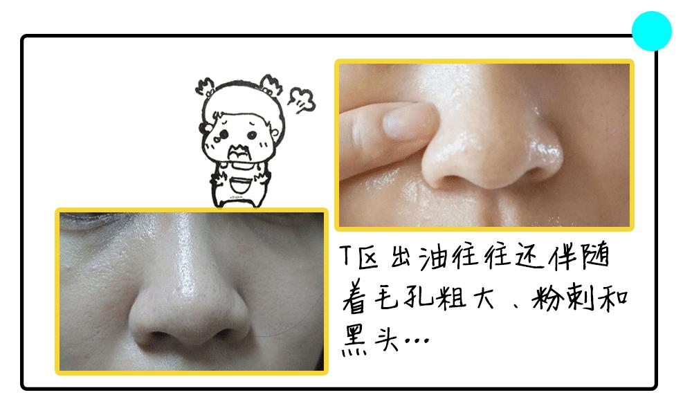 易出油皮肤怎么改善,混干皮t区出油怎么化妆