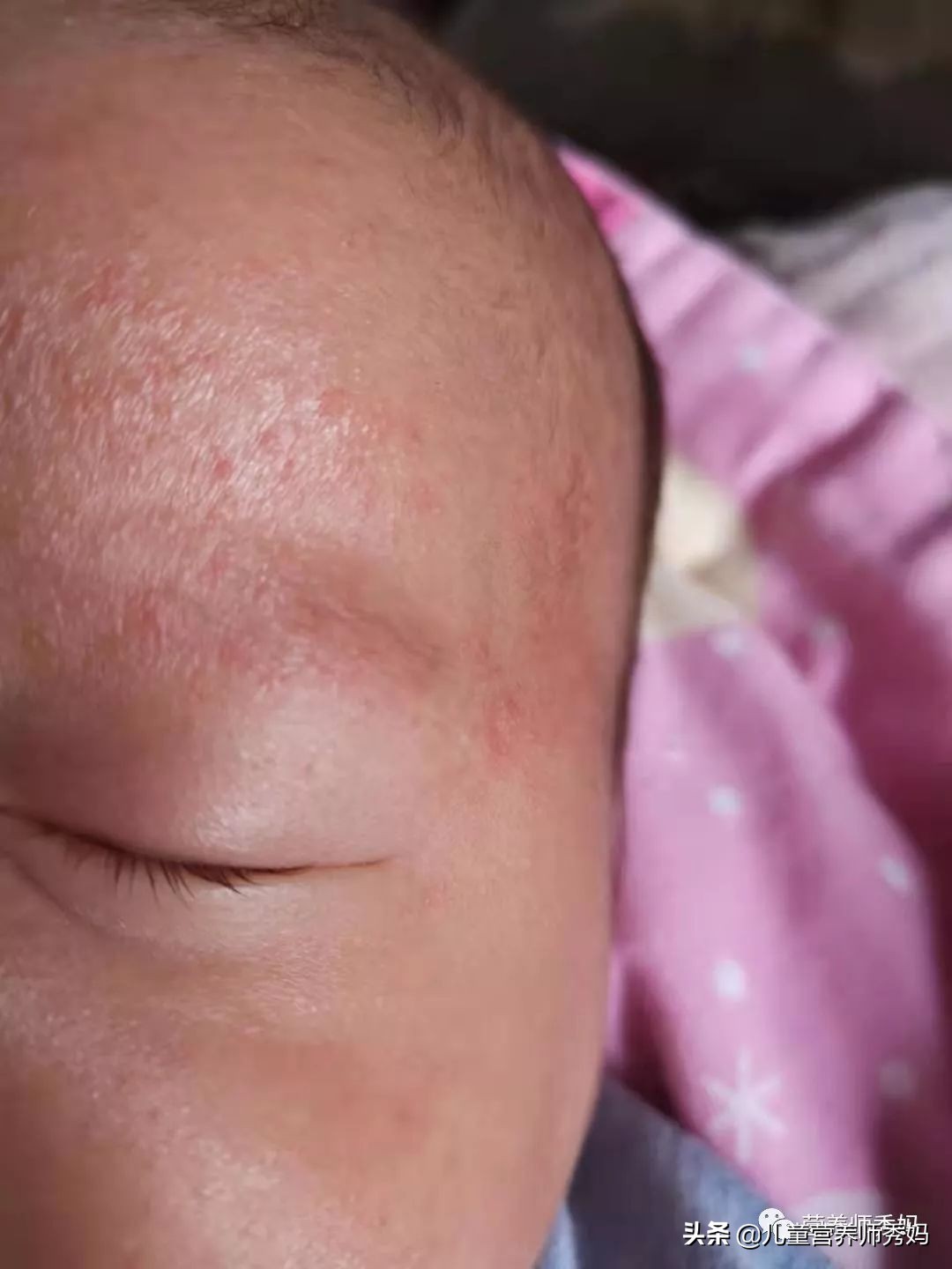 湿疹有时反复发作吃什么药最好,湿疹严重万一治不好后果会怎样