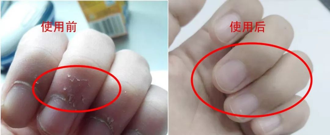 手纹深粗糙是不是比较好,手纹深粗糙干燥怎么办