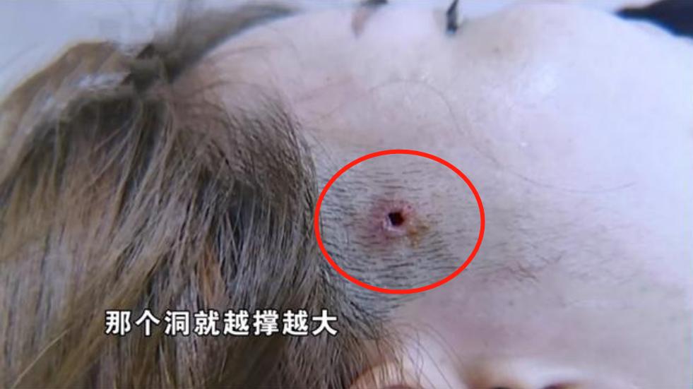 做完面部线雕有后遗症如何维权,做线雕毁容留下后遗症怎样打官司