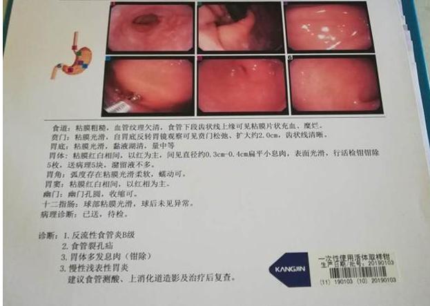 反流性食管炎B级，食管裂孔疝，慢性浅表性胃炎，胃病越拖越严重