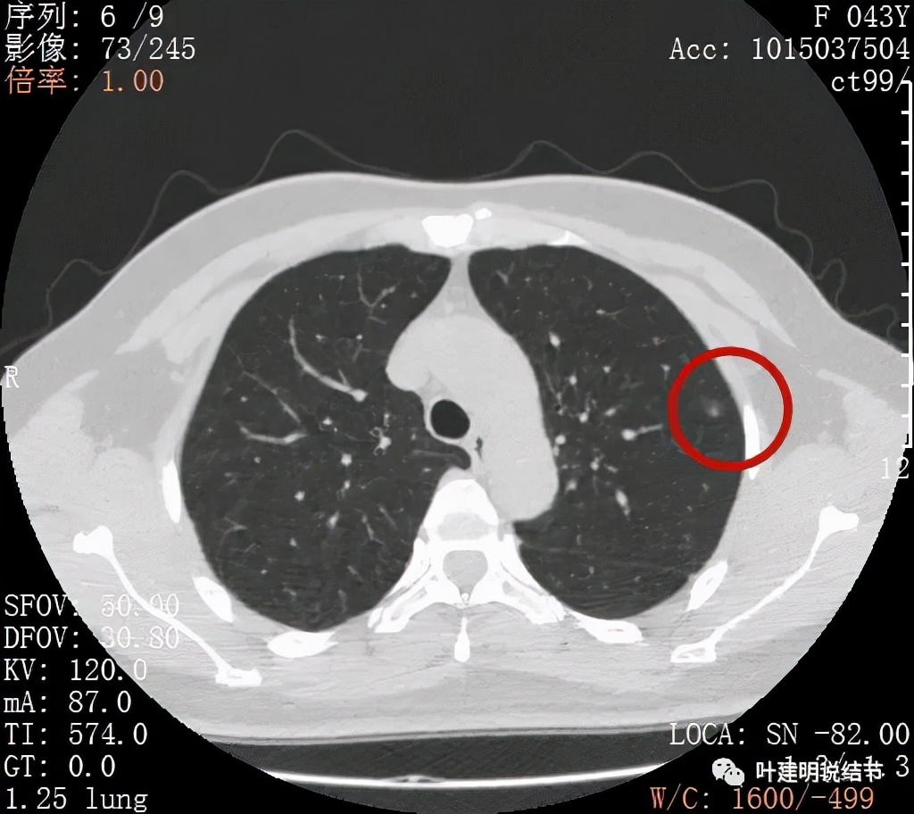 怎样从病理报告看是不是原位癌,原位腺癌切除子宫要开刀吗