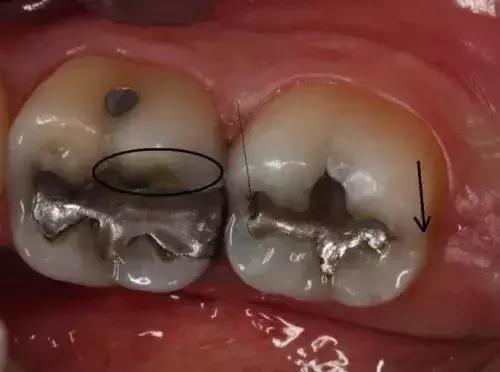 原来牙齿能让*毒冰**原形毕露！牙医：发现这种牙况特征请小心远离