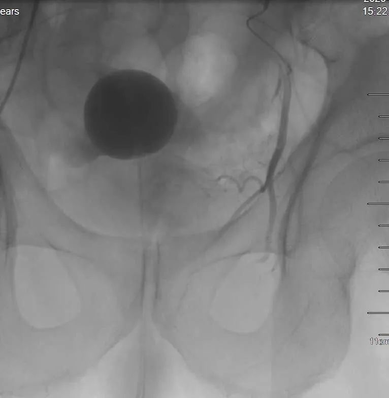 山东大学第二医院前列腺栓塞术,聊城市第二人民医院华美院区