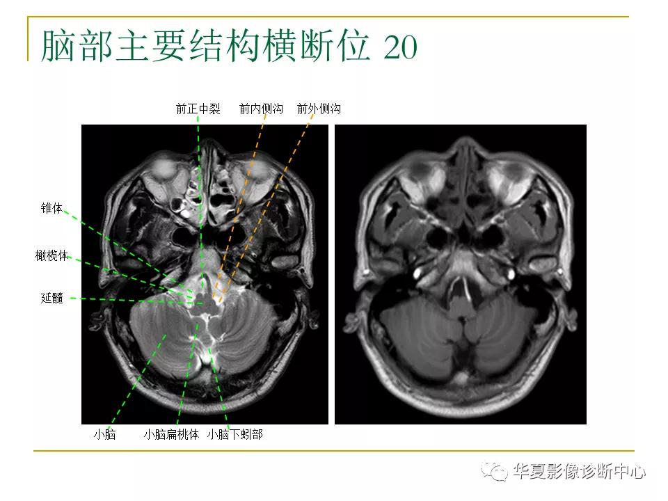 中国人脑立体定向mri应用解剖图谱,脑mri示意图