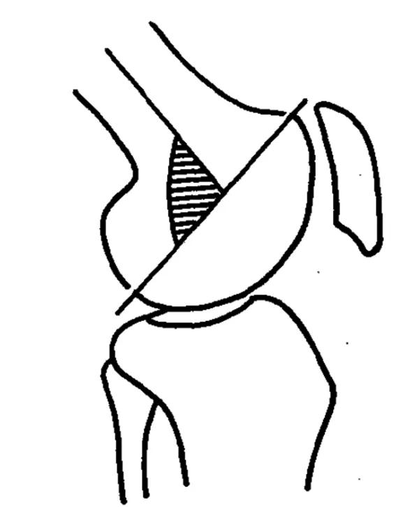 膝关节x线片可以查出啥,膝关节间隙x线测量方法