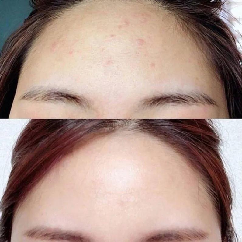 十年战痘肌自救指南,十年痘肌怎么抗痘