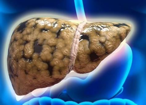 妊娠胆囊炎饮食注意事项,孕妇得了胆囊炎用什么方法好得快