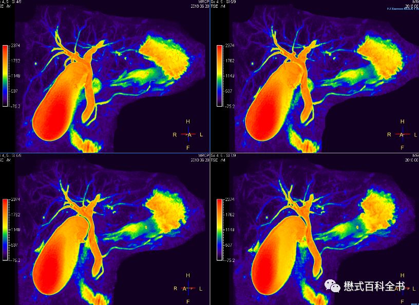 开展mrcp技术,mrcp检查操作流程