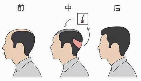 有了这个神器,英国人的脱发有救了?