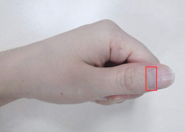 指甲全是竖条纹和白点是怎么回事,指甲竖条纹没有月牙怎么回事