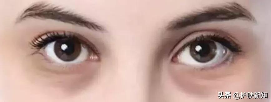 太有才了,竟然有人拿痔疮膏治疗黑眼圈