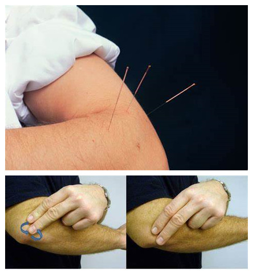 网球肘是否常见肘前外侧痛,网球肘能引肘关节和肩关节疼痛吗