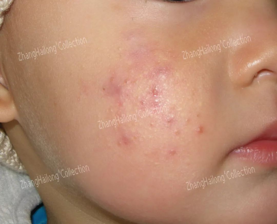 新生儿青春痘,小孩长青春痘怎么办