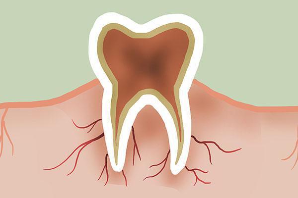 牙缝抠出来的硬物是什么,牙缝有小石子怎么去除