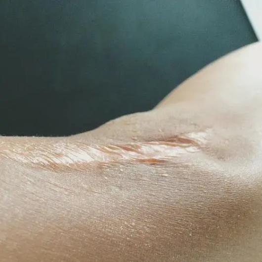 重庆北碚九院疤痕增生修复方法,上海九院孙沣