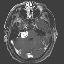 听神经瘤可能一辈子不发作吗,听神经瘤是什么病