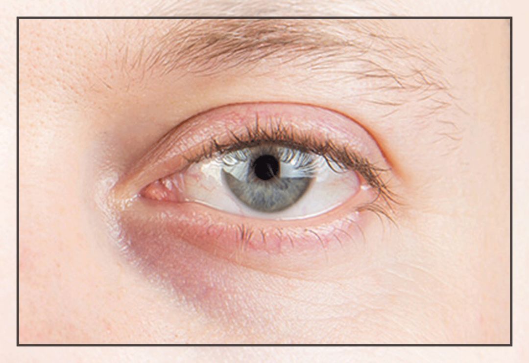 花了10800块去黑眼圈没效果,网上治疗黑眼圈靠谱么