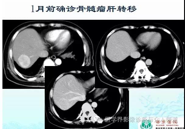 ct造影剂过敏反应及处理方法,增强ct碘过敏该用什么造影剂