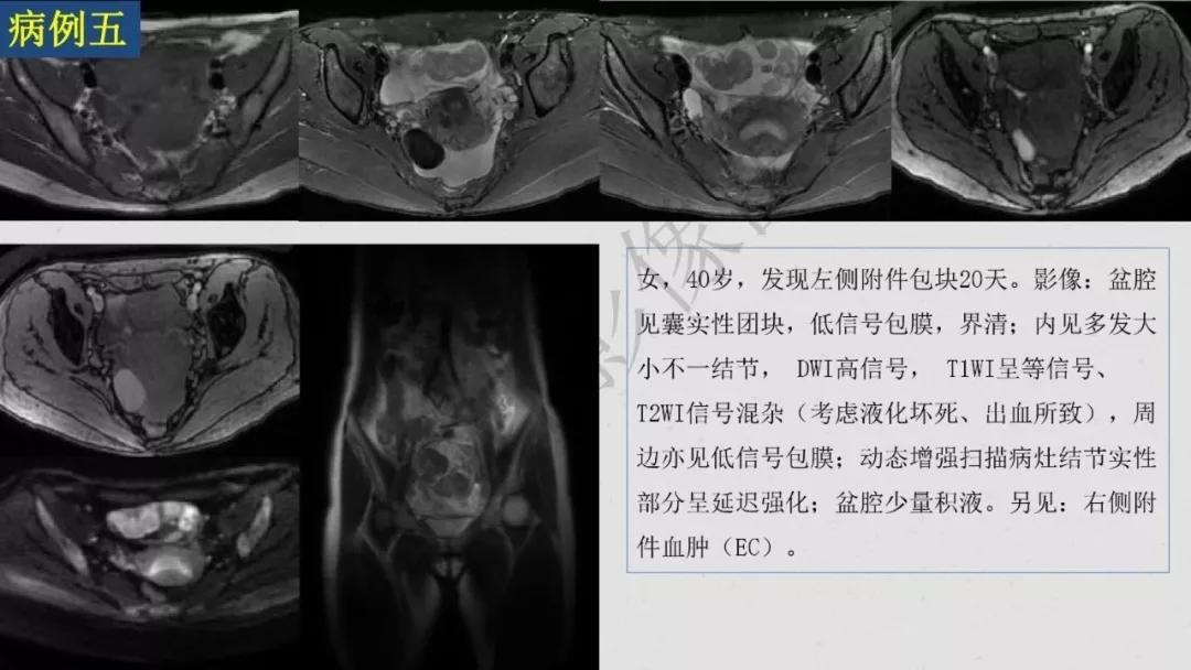 卵巢原发肿瘤的分析思路