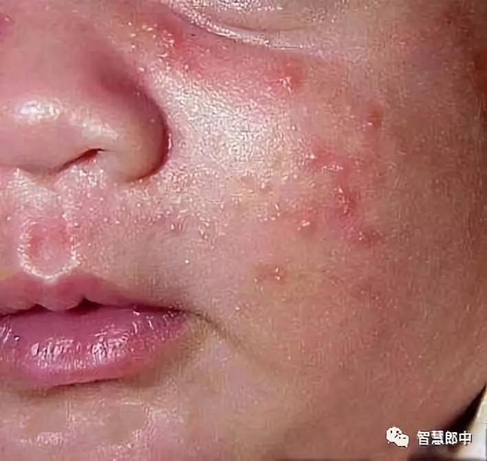 新生儿的几种生理现象图片,新生儿正常生理现象