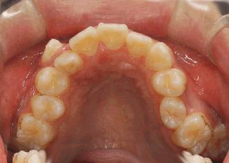 有严重牙周病能种牙么,得了牙周病还能刷牙吗