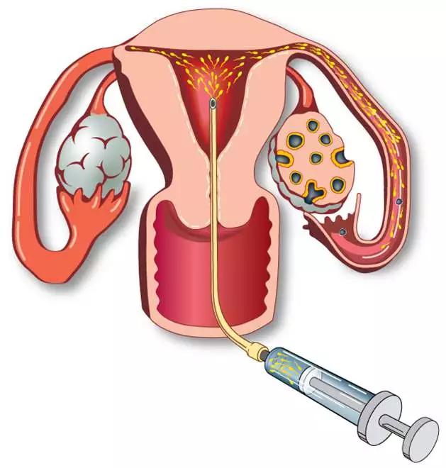 人工授精后还可以自然怀孕吗,人工授精后如果怀孕会有哪些感觉