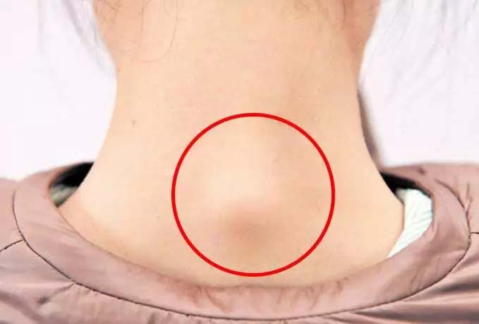 富贵包与个人的习惯,富贵包对人有什么影响吗