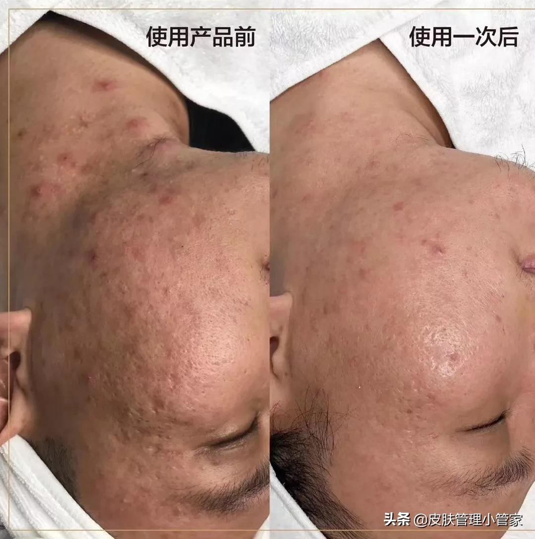 皮肤痘坑多黑头多如何护理皮肤,皮肤暗沉长痘黑头多怎么办