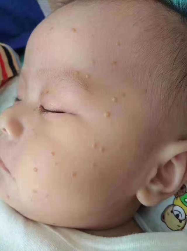 扁平疣—孕期妈妈之痛