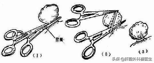 痔疮并不严重可以用什么药好起来,痔疮手术治疗的几个方法
